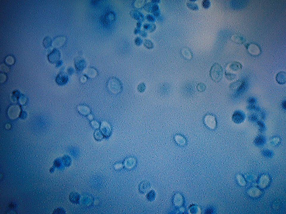 什么是白色念珠菌，有什么症状？